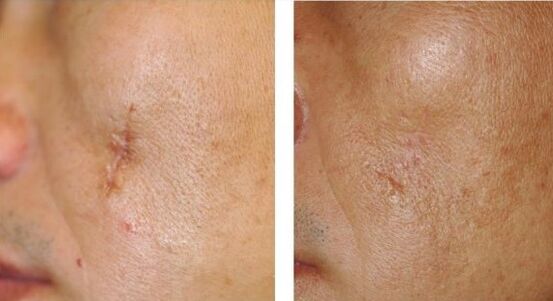 The result of the laser