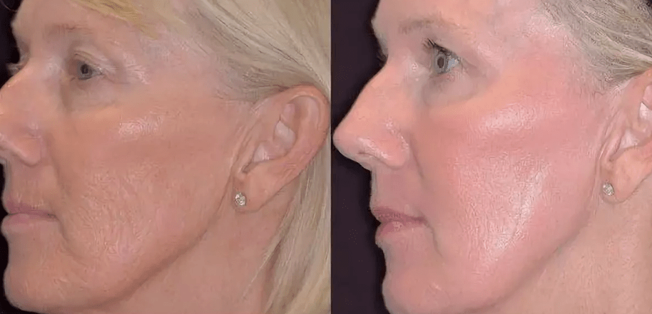 Laser photothermolisis before and after