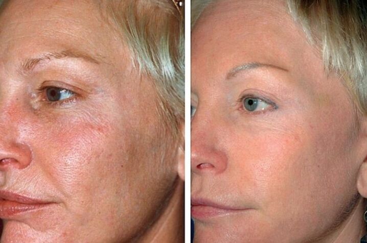 Before and after the rejuvenation procedure