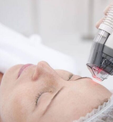 Photothermolisis