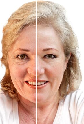 Face rejuvenation