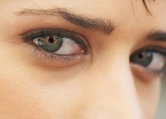 Sweet circles under the eyes