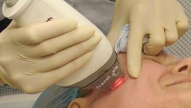 How fractional skin rejuvenation is performed