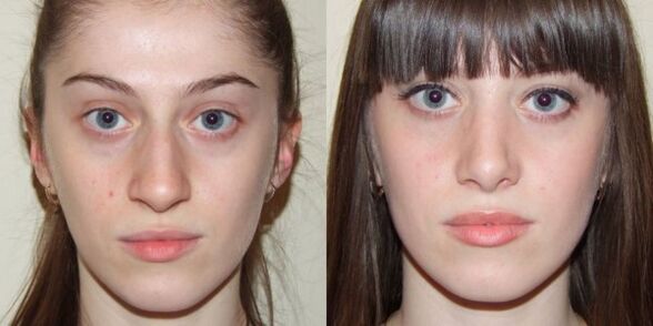 Girl before and after facial skin rejuvenation with plasma